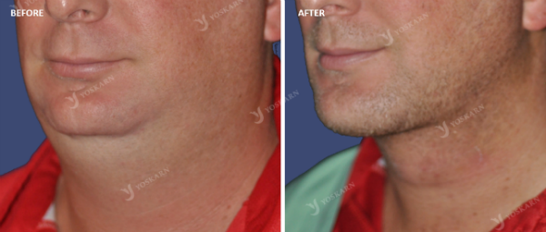 Chin Implant 3[1].png (600×255)